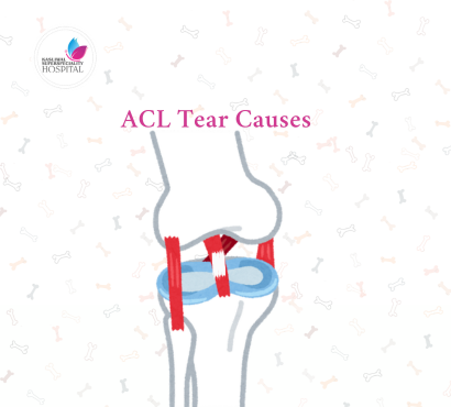 ACL Tear Causes, Symptoms & Recovery for Athletes